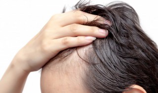 怎么拯救发际线 植发有用吗,可以维持多久