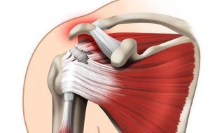 肌肉拉伤怎么快速恢复 肌肉拉伤怎么快速恢复正常