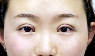 单眼皮怎么弄双眼皮? 单眼皮怎么弄双眼皮视频