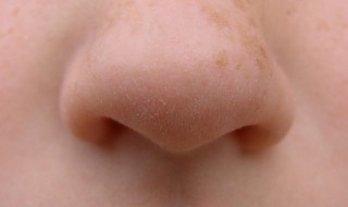 闭口粉刺是怎么形成的 闭口粉刺是怎么形成的要注意哪些 能避免复发