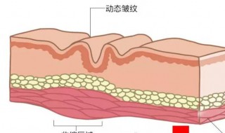 法令纹怎么去除最有效 法令纹怎么去除最有效安全