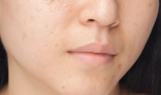 长痘痘是什么原因（下颚长痘痘是什么原因女生）