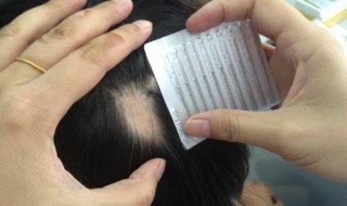 斑秃是什么原因造成的（女性斑秃是什么原因造成的）