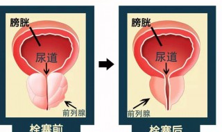 前列腺是什么 前列腺是什么病状