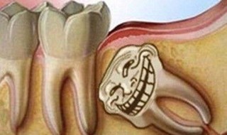 拔完智齿后注意事项 拔完智齿后注意事项和禁忌