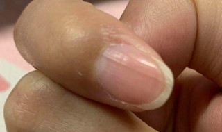 甲黑线多久能自己消失 指甲有一毫米小段黑线