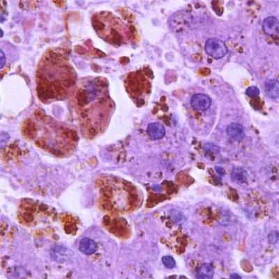 尿胆红素是什么