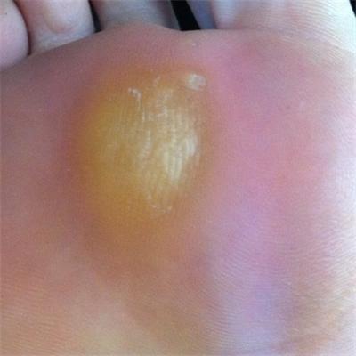 脚上的老茧怎么去除