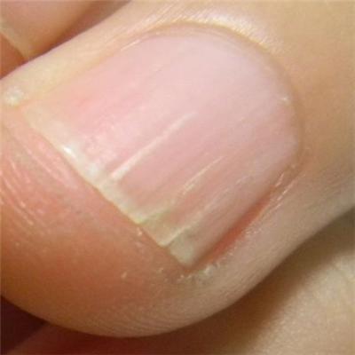 手指甲裂口怎么办