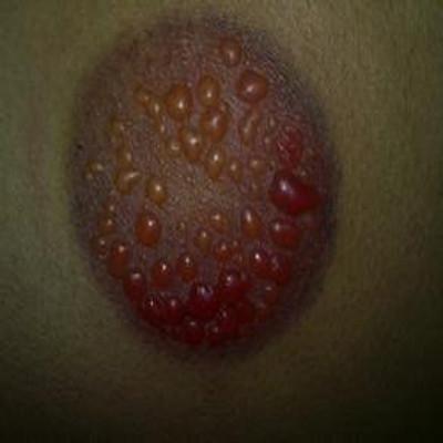 拔罐水泡怎么处理