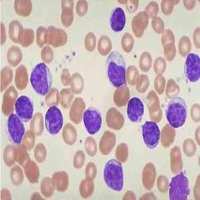 宫颈细胞学检查是什么