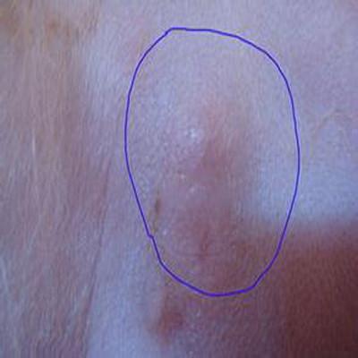 腰上长了个硬疙瘩是怎么回事