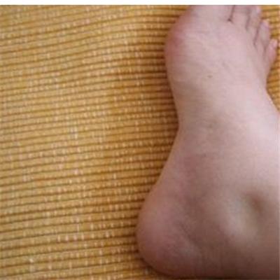 腿浮肿是什么原因引起的