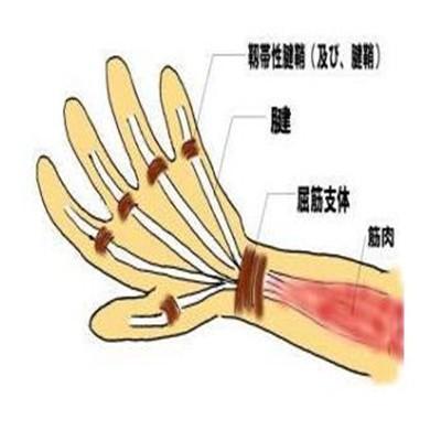 腱鞘炎怎么办