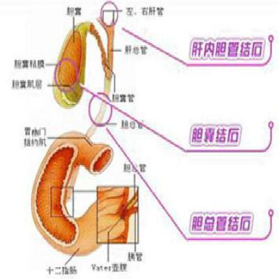 胆囊炎吃什么好