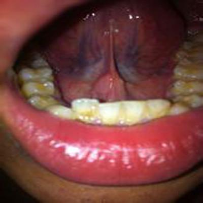 舌头下面溃疡怎么办