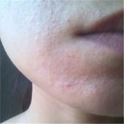 脸上发痒起小疙瘩是怎么回事？