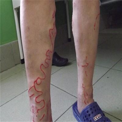 静脉曲张术后注意事项