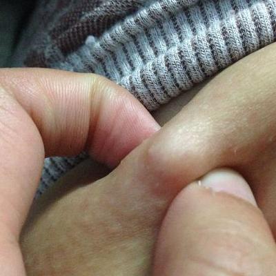 皮下长疙瘩是什么原因