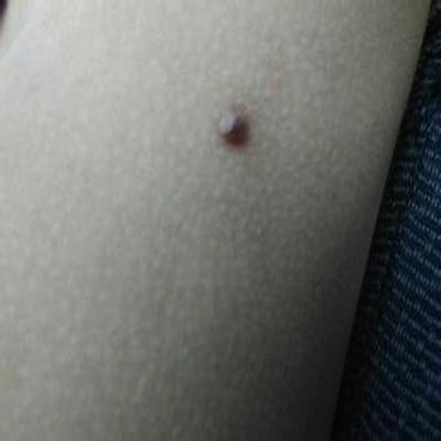 身上小肉丁怎么治