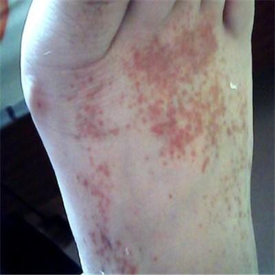 脚上起红点的原因及该怎么办？