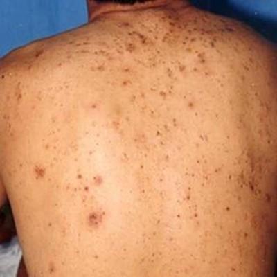 身上长肉疙瘩是怎么了