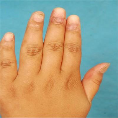 只有大拇指有月牙怎么办