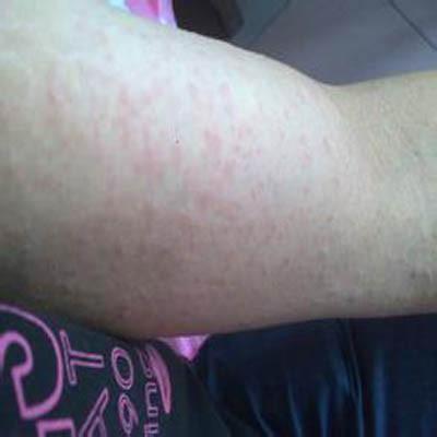 身上突然起红疙瘩很痒怎么办