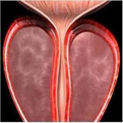 前列腺囊肿的危害有哪些