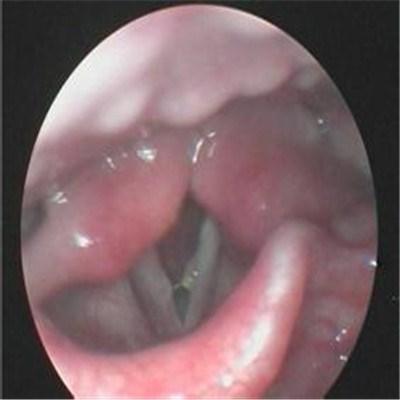 声带小结怎么办