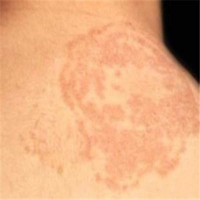 花斑癣的发病原因是什么