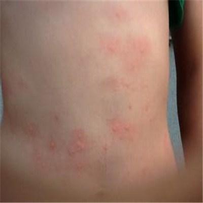 长时间皮肤红点怎么做