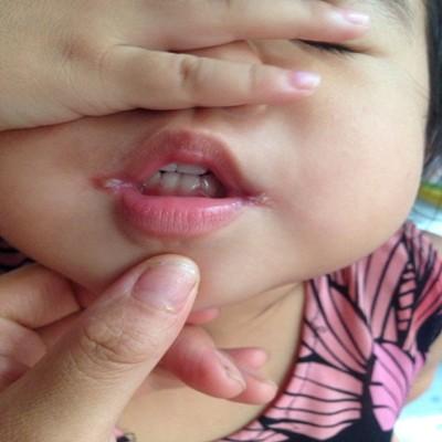 嘴角起泡怎么好的快