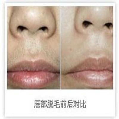 激光脱唇毛需要几次