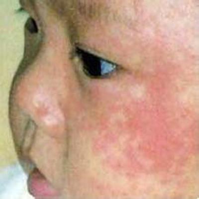 风疹最佳治疗方法是什么