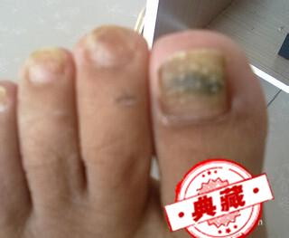 指甲变黑是怎么回事啊？今天突然发生指甲变黑了