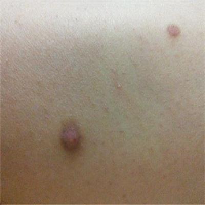 身上起红疙瘩很痒怎么回事