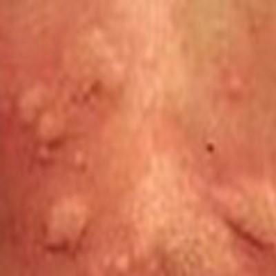 寻麻疹症状是什么