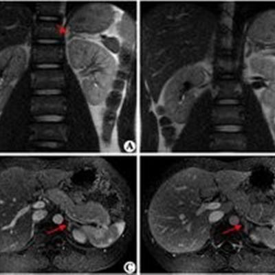 肾上腺增生的症状