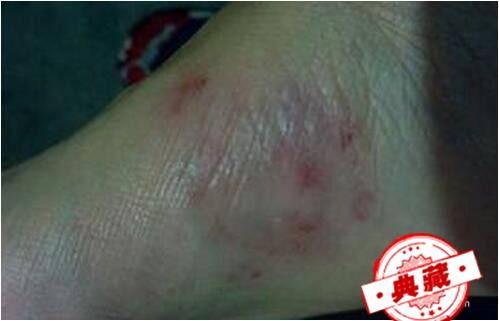 夏天脚底长水泡脱皮出汗怎么办呢？