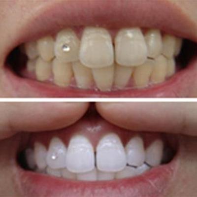 牙周炎根治怎么办