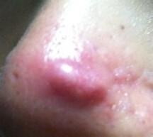 鼻子上长脓包型痘痘怎么处理？挤了很多次了？