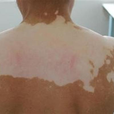 白癜风初期的症状有什么