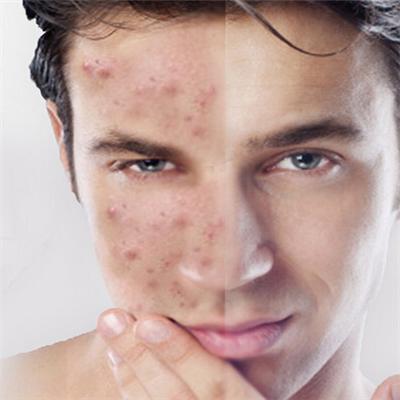 男士祛痘的方法有哪些