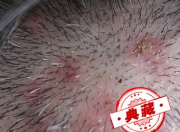 头上长痘痘是什么原因？夏天头上有很多的红痘痘