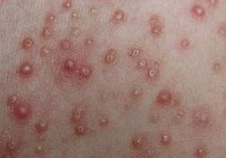 怎样治疗头部毛囊炎