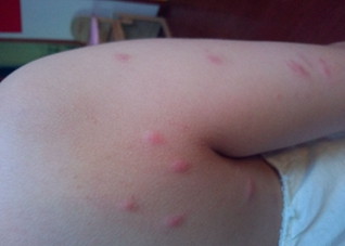 过敏起疙瘩怎么办