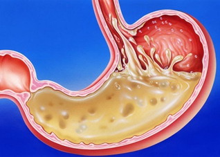 胃酸恶心怎么处理