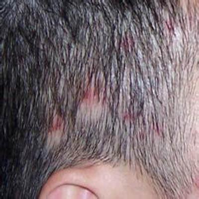 头皮毛囊炎怎么引起的