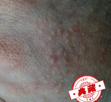 手背起小疙瘩很痒怎么办？有图有真像